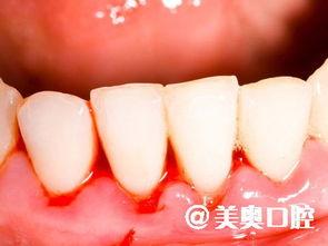 成人牙龈出血视频