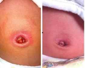 成人脐炎消毒视频,视频教学助力成人护理